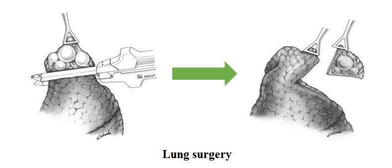 lung_surgery-Linear-Cutter-Stapler-Uses