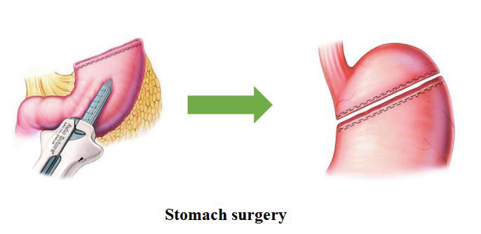 stomach_surgery---Linear-Cutter-Stapler-Uses